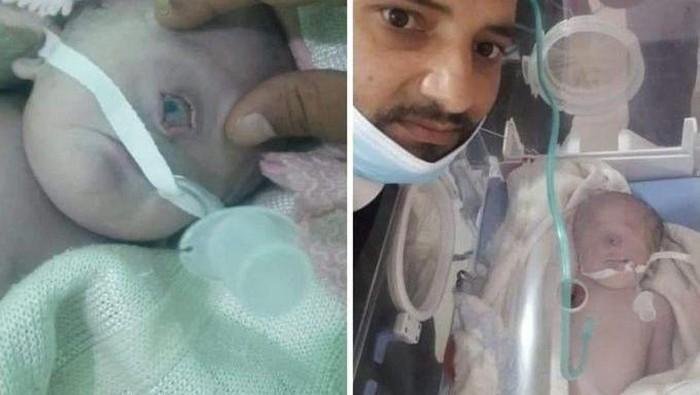 Viral! Bayi Bermata Satu Lahir di Yaman, Ini Penampakannya
